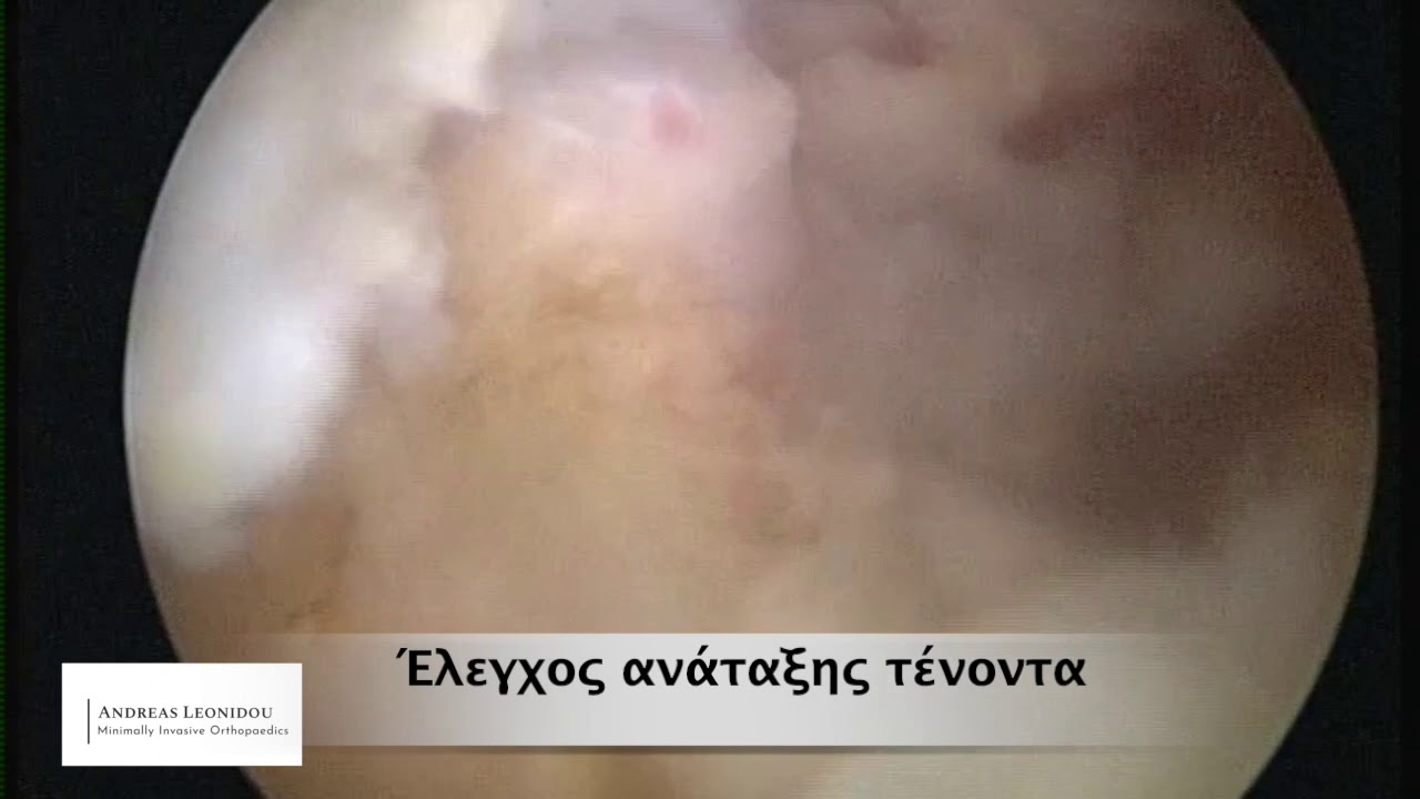 Αρθροσκόπηση Ώμου - Συρραφή Στροφικού Πετάλου