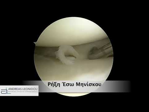 Ρήξη μηνίσκου - αρθροσκόπηση γόνατος