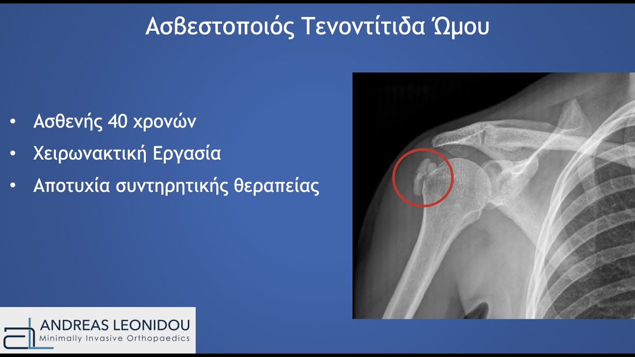Ασβεστοποιός τενοντίτιδα - αρθροσκόπηση ώμου