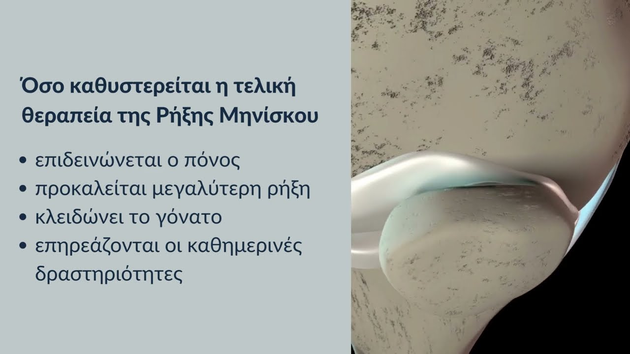 Πιθανοί κίνδυνοι εάν αμελησω τη ρήξη μηνίσκου