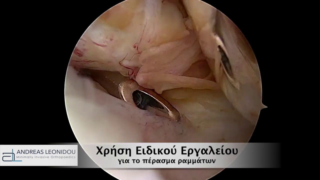 Αρθροσκόπηση Ώμου - για  αντιμετώπιση εξαρθρήματος